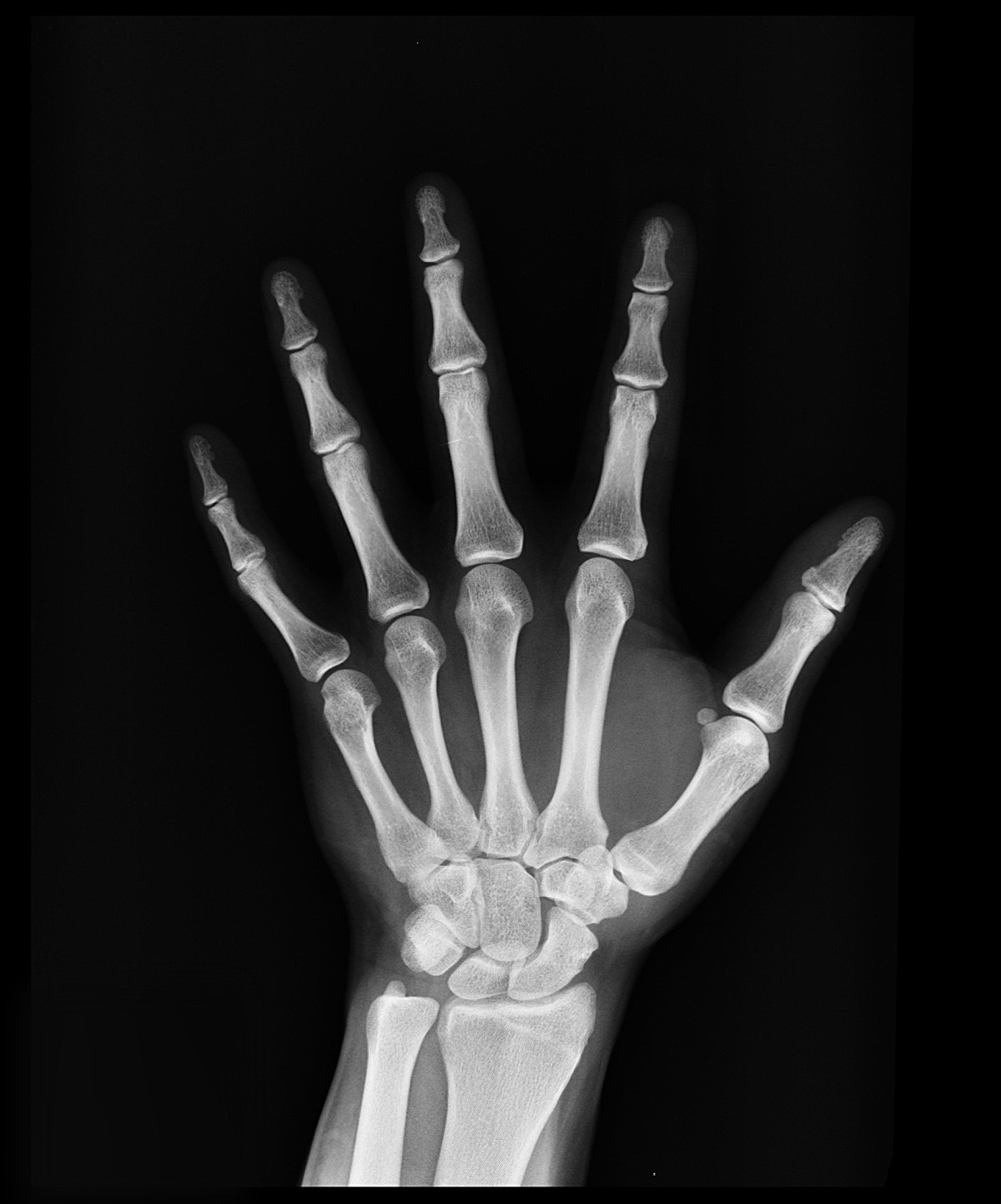 radiografia de mano