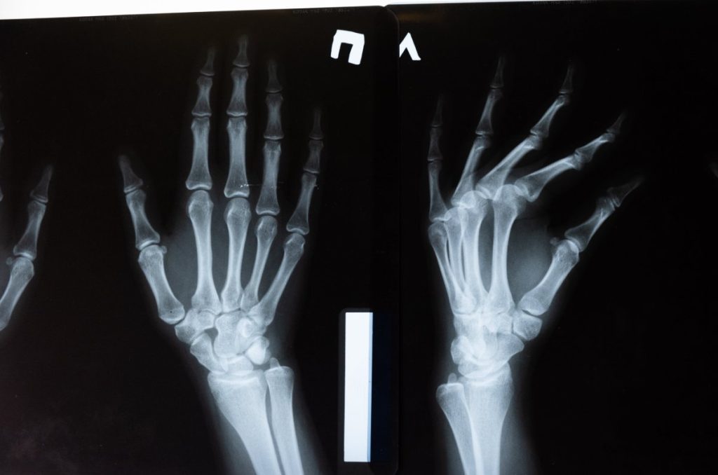 radiografía de manos con artritis