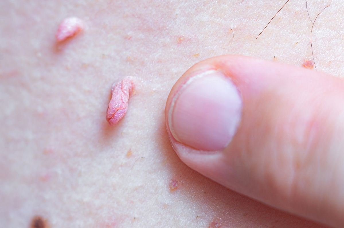 ¿Cómo detectar el Virus del Papiloma Humano (VPH) en hombres?