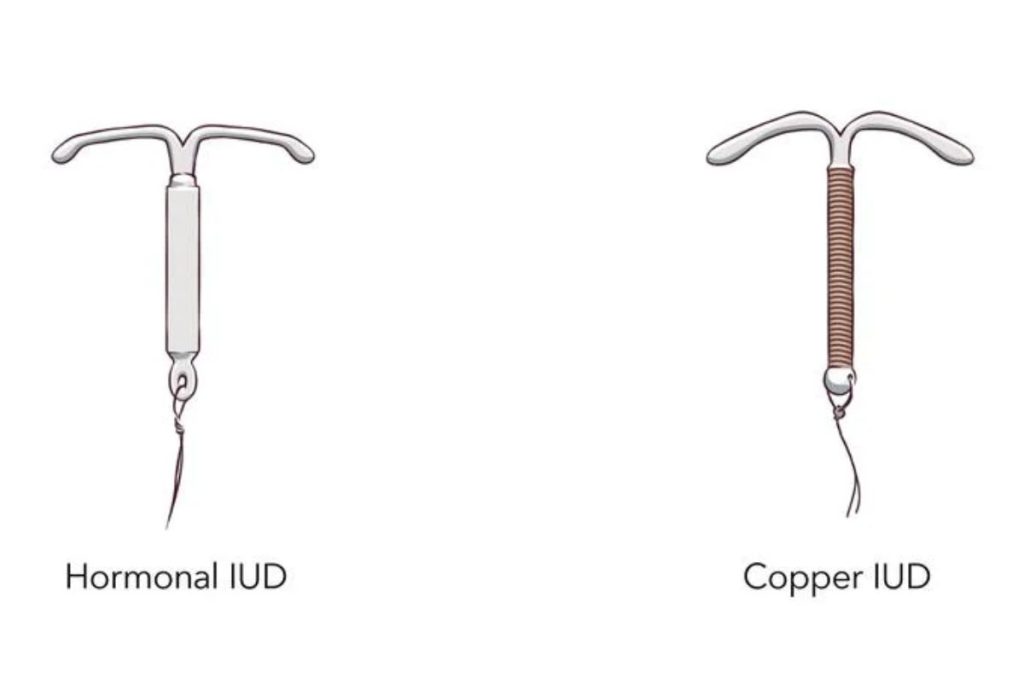 DIU de cobre y hormonal