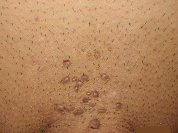Virus del papiloma humano (VPH): ¿Cómo detectarlo en hombres? 0