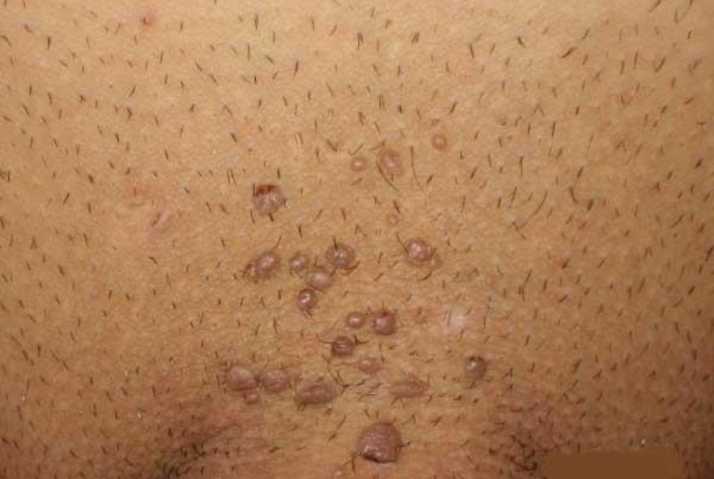 Detección del virus del papiloma humano en hombres