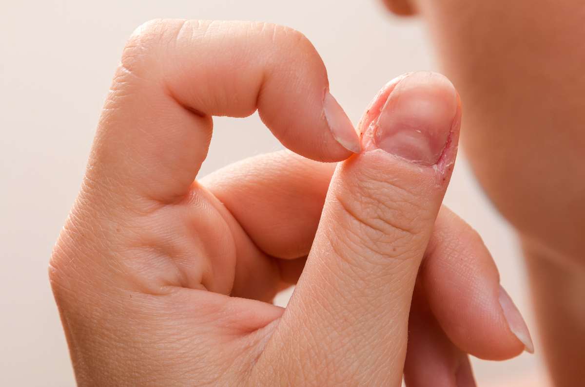 Dermatofagia: el trastorno psicológico que hace que te comas la piel de tus dedos