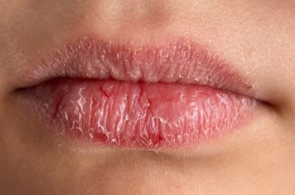 5 remedios caseros para curar los labios resecos en primavera 2