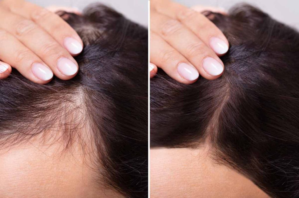 Caída de cabello en adolescentes: ¿cómo evitarlo y cuáles son las causas? 0