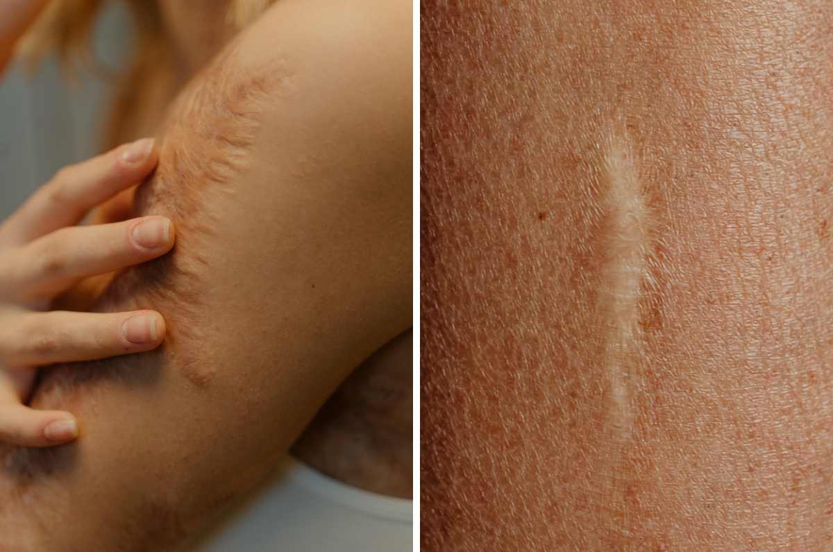 Las mejores cremas para evitar cicatrices después de una cirugía