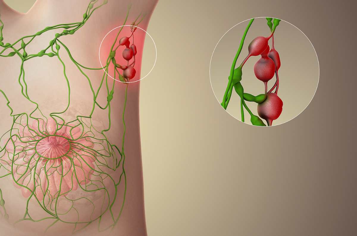 ¿Qué son y cómo se relacionan las mamás axilares y el cáncer de mamá?