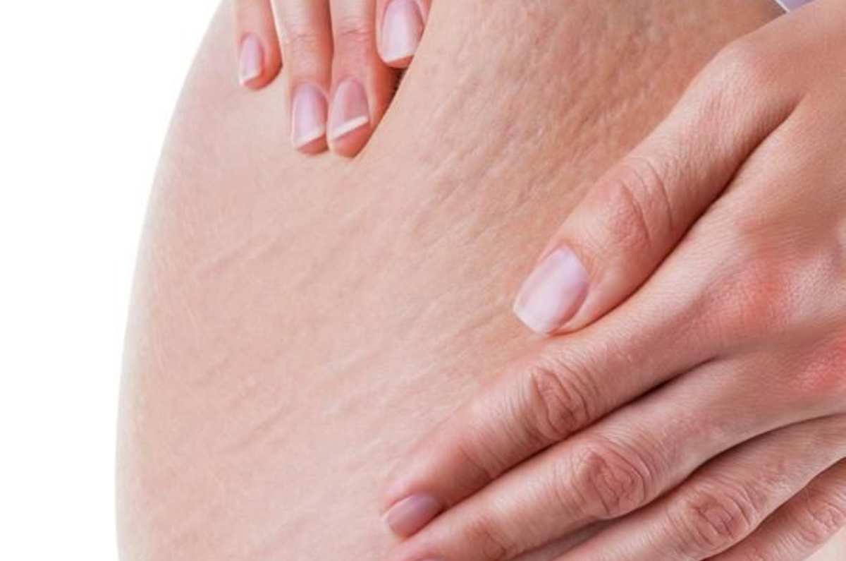 Alimentos que deberías comer para PREVENIR las estrías