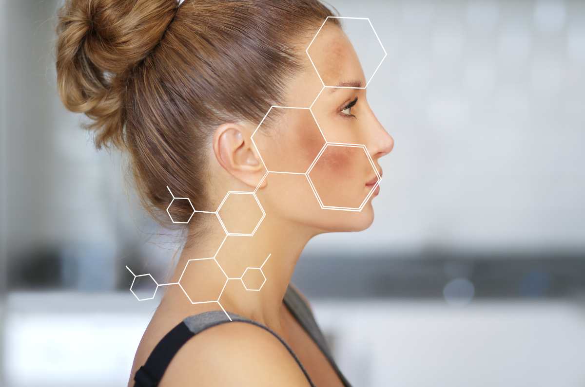 Melasma en la cara: control, tratamiento y prevención