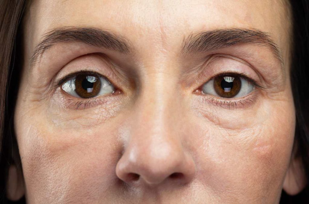 Quitar ojeras con ácido hialurónico