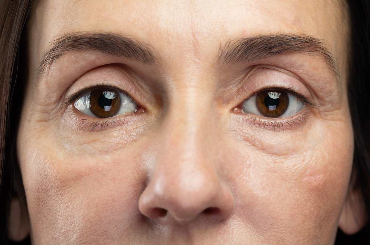 Cuál es el mejor tratamiento para quitar ojeras, según una experta
