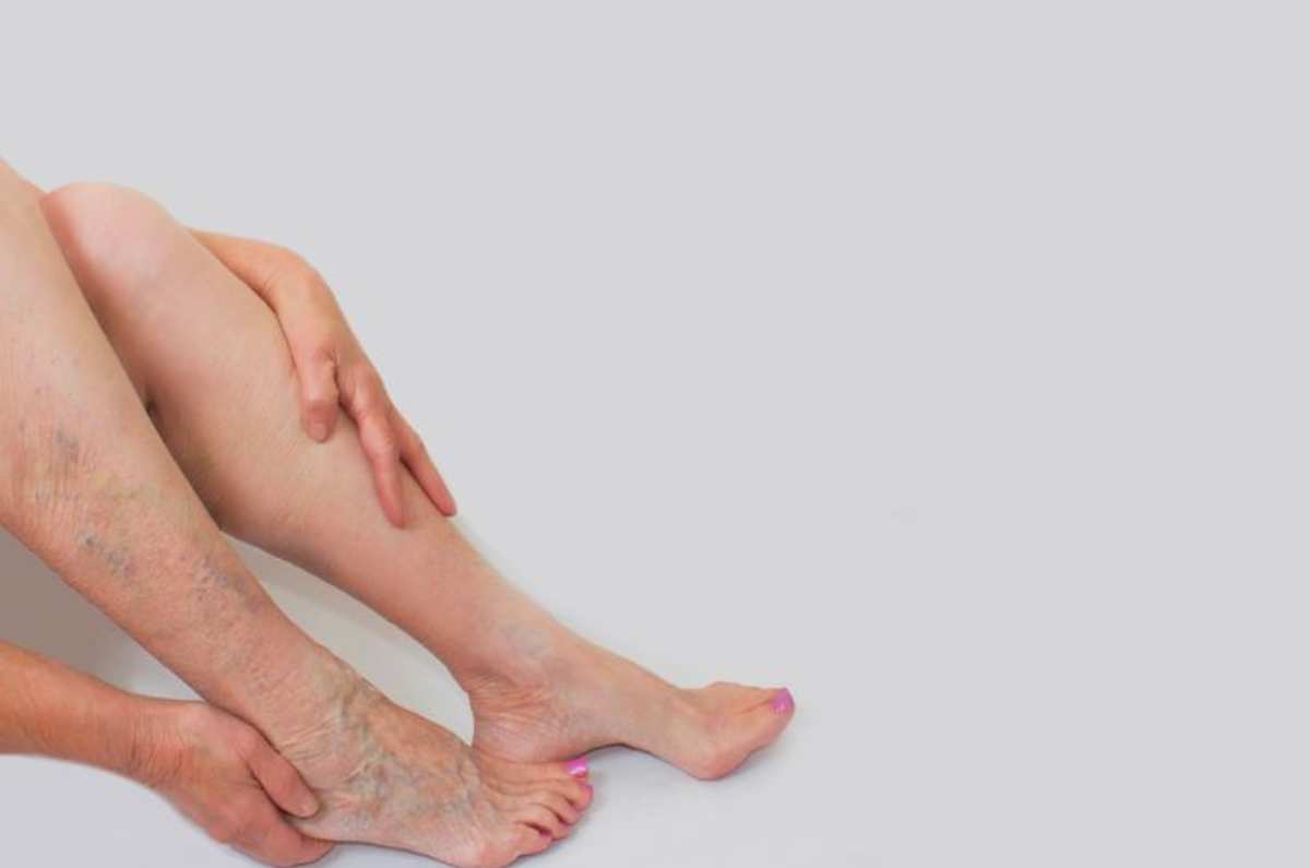 5 ejercicios para varices que además te darán una increíble figura