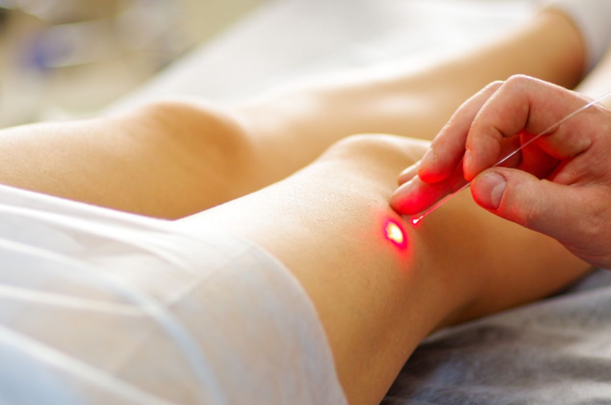 ¿Cuánto cuesta hacerte laser para las varices?