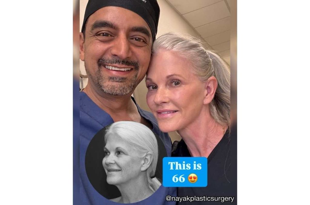 Lisa, de 66 años, después de 10 meses de su lifting