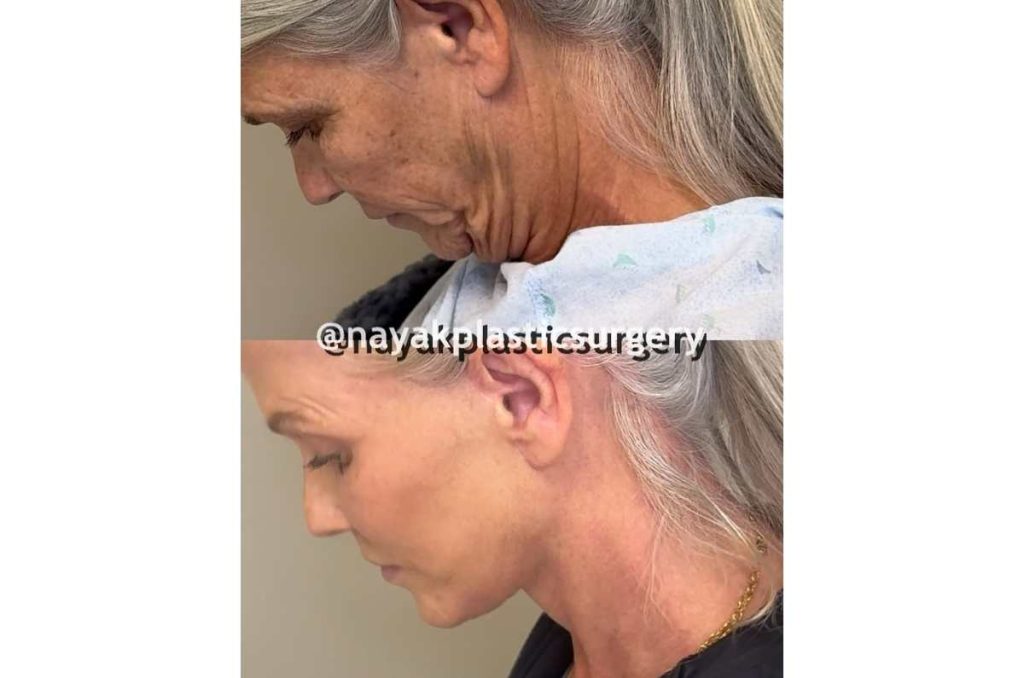 La impactante transformación de una mujer de 66 años luego de someterse a un lifting de cara 2
