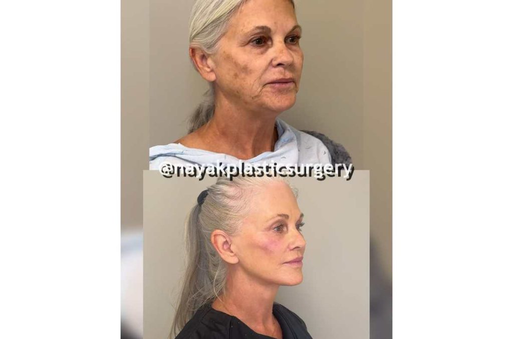 La impactante transformación de una mujer de 66 años luego de someterse a un lifting de cara 3