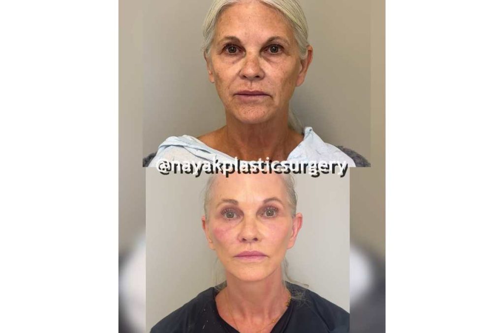 Cambio impactante con lifting en mujer de 65 años