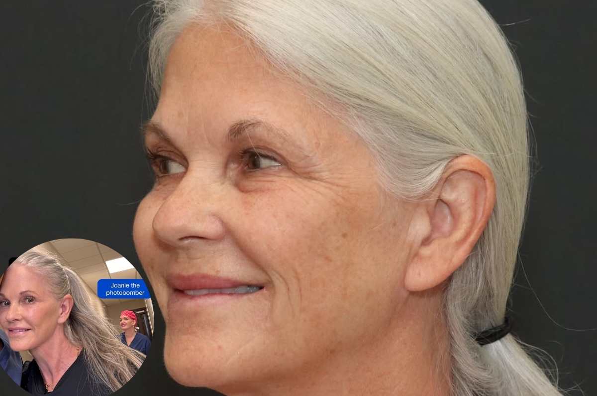 La impactante transformación de una mujer de 66 años luego de someterse a un lifting de cara
