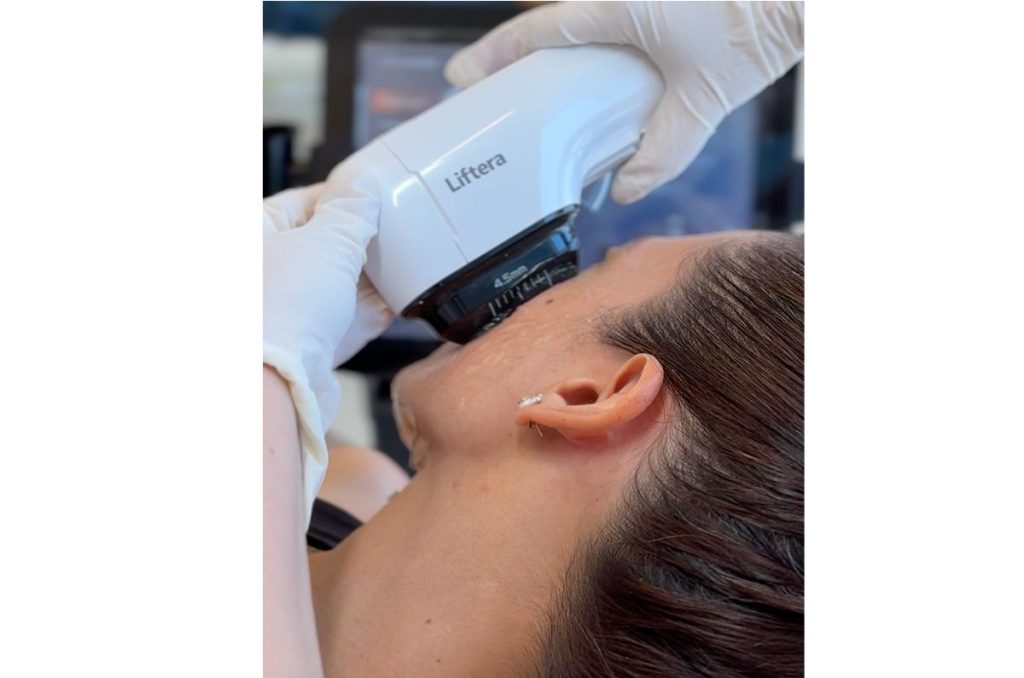Cómo conseguir un efecto lifting en el rostro con este procedimiento 1