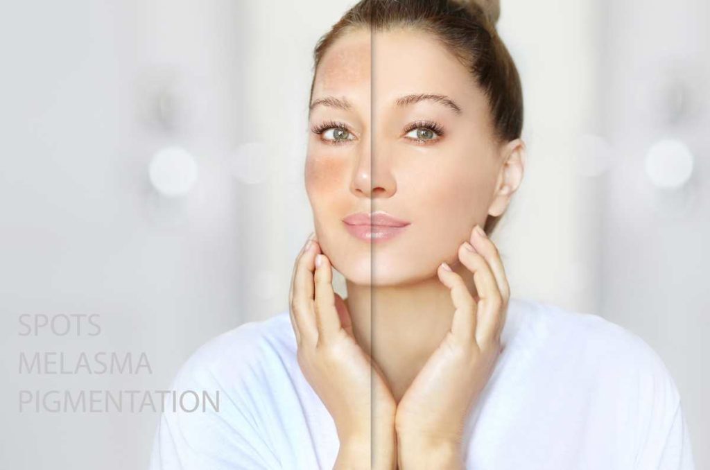 tips para quitar manchas en la piel