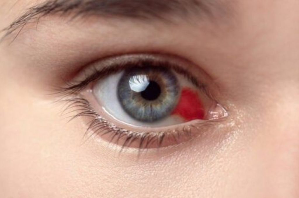 derrame-en-el-ojo-pinterest-2