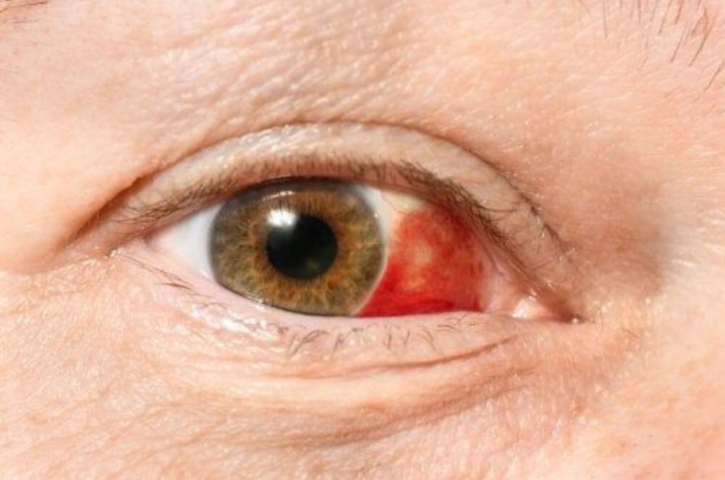 derrame-en-el-ojo-pinterest-2