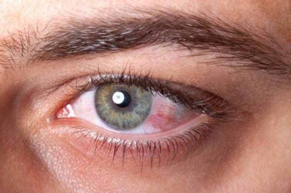 derrame-en-el-ojo-pinterest-2