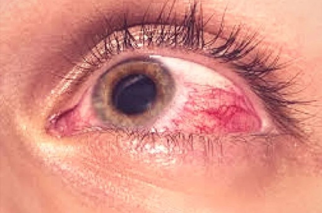 derrame-en-el-ojo-pinterest-2