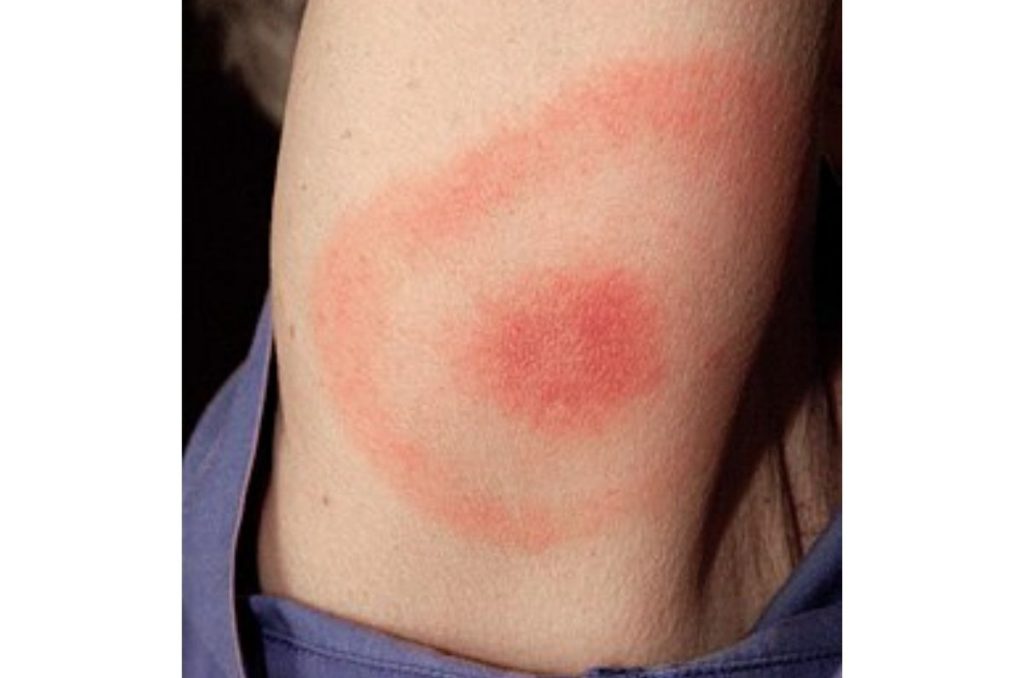 Síndrome de Lyme