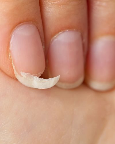 Causas de las uñas quebradizas remedios para uñas