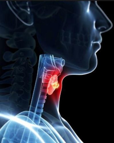 Cáncer de toroides