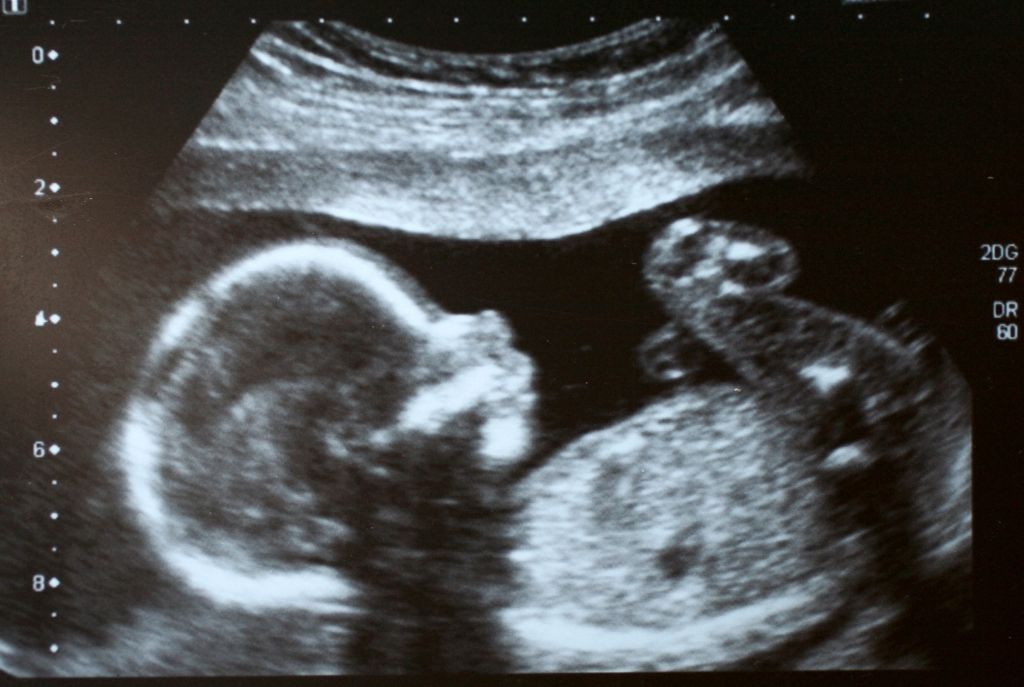 Imagen de un ultrasonido que muestra a un bebé dentro del vientre de su mamá, una forma natural de cómo llegan los bebés al mundo