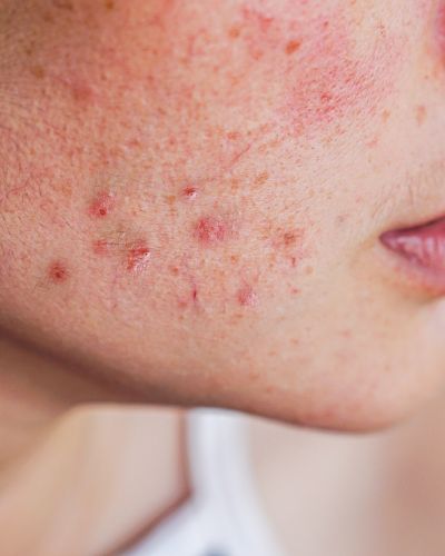 Mujer con granitos en la piel 