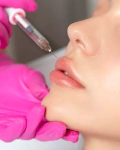 Ácido hialurónico en los labios