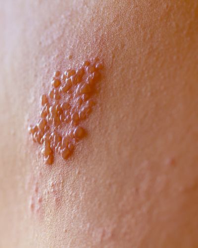 El virus del herpes zóster puede causar serias lesiones en el cuerpo