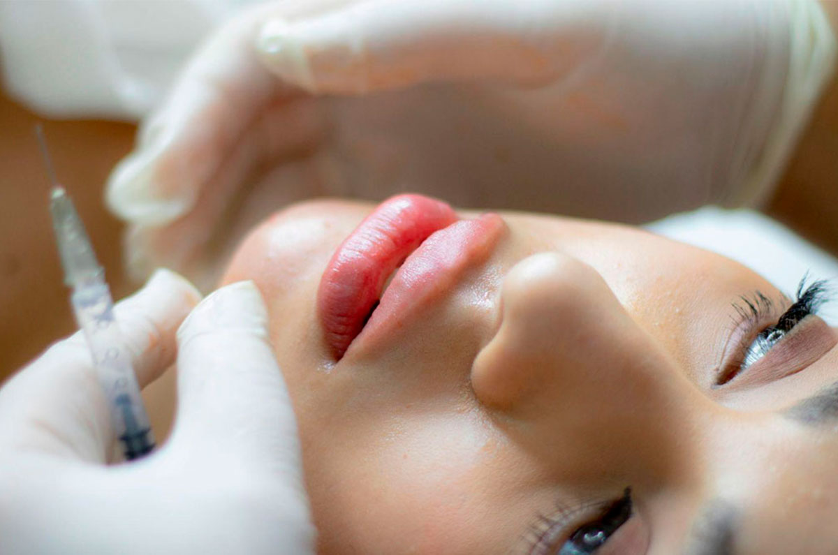 Aumento de labios sin cirugía: qué esperar y cómo prepararte para un cambio sutil y natural
