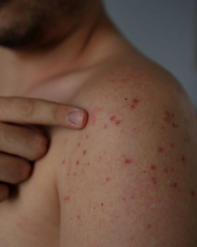 erupción cutánea con manchas rojas en el hombro de una persona, síntoma característico del sarampión.
