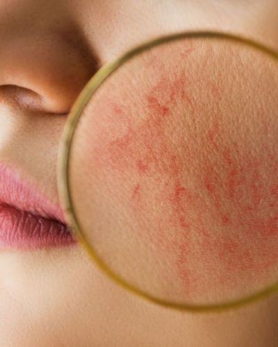 La irritación en tu piel puede provocarse por combinar mal los productos de skincare