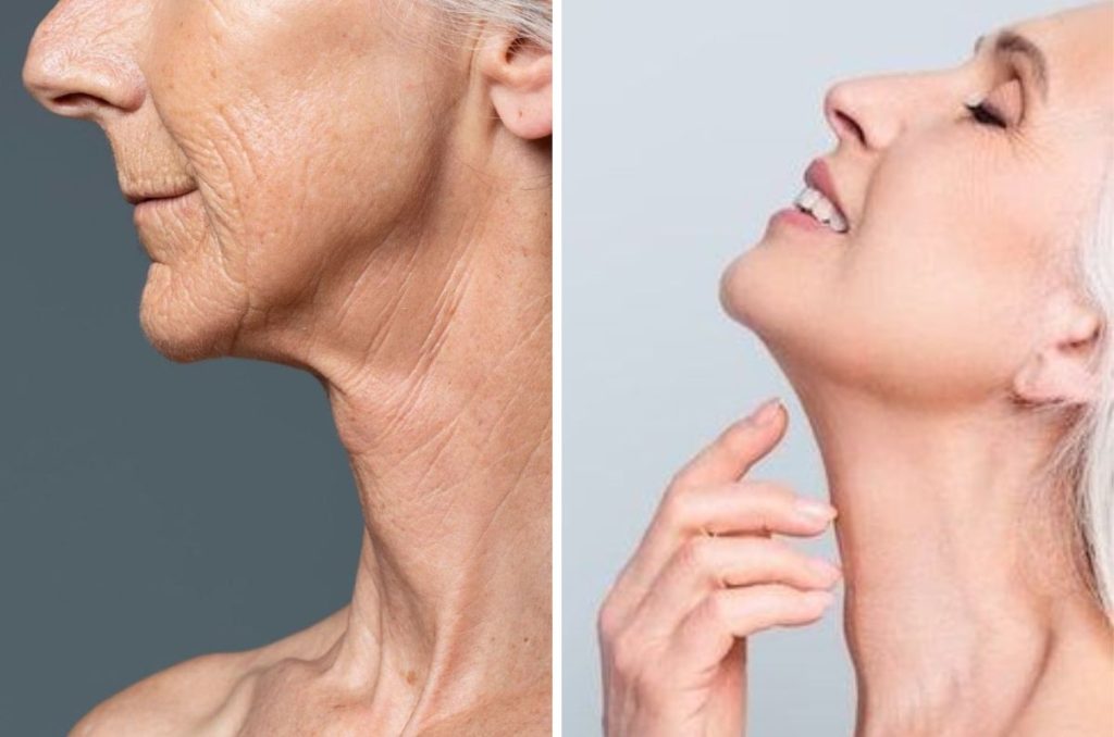 Comparación de flacidez del cuello y mejora en la firmeza de la piel