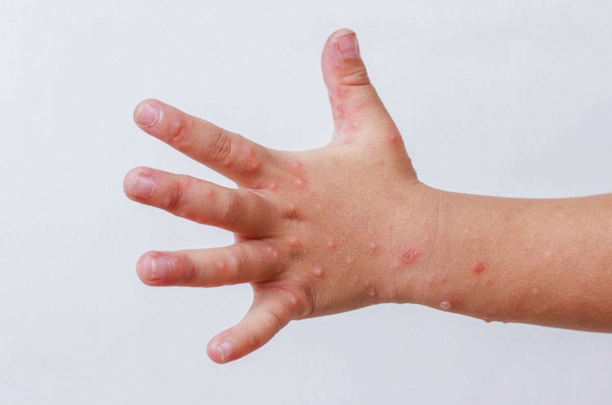 Sarampión en México: Aumentan los casos en 32 estados, las señales y medidas de prevención