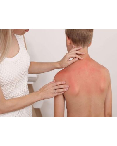 Aquí encontrarás una guía sencilla para cuidar las quemaduras solares en niños, aliviar las molestias y ayudar a que su piel se recupere de forma segura.