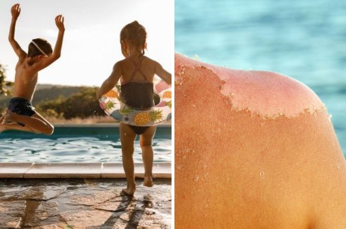 ¿Cómo cuidar las quemaduras solares en niños? Guía básica para aliviarlas