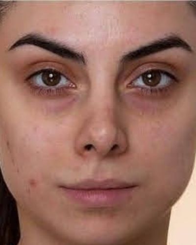 El color de tus ojeras y lo que revela sobre tu salud