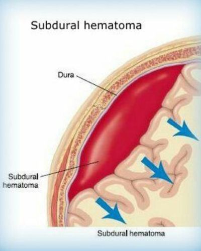 Hematoma subdural