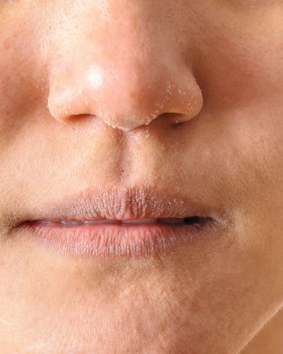 Primer plano de nariz y labios con resequedad visible y piel descamada, señal de falta de hidratación.